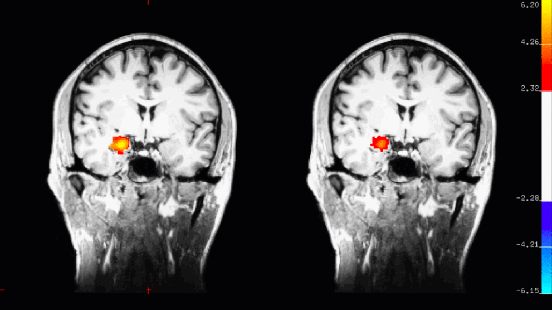 Sådan bliver du mentalt stærk (psykologens guide) 1 Amygdala 1